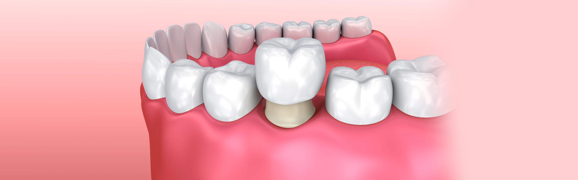 Permanent Dental Crowns vs. Temporary Is There a Difference