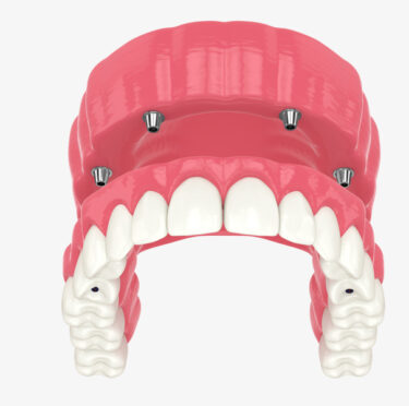 all-on-4 dental implants