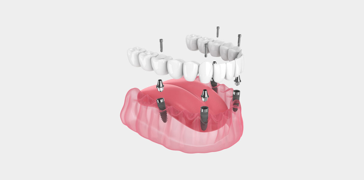 The Evolution of Tooth Replacement- Exploring All-on-4® Dental Implants