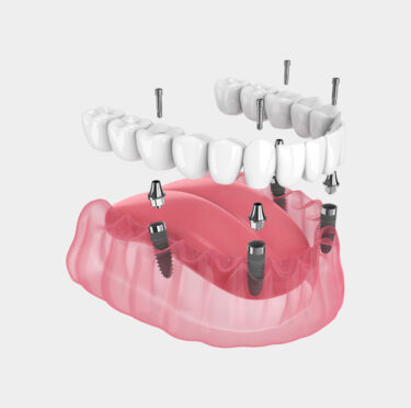 The Evolution of Tooth Replacement- Exploring All-on-4® Dental Implants